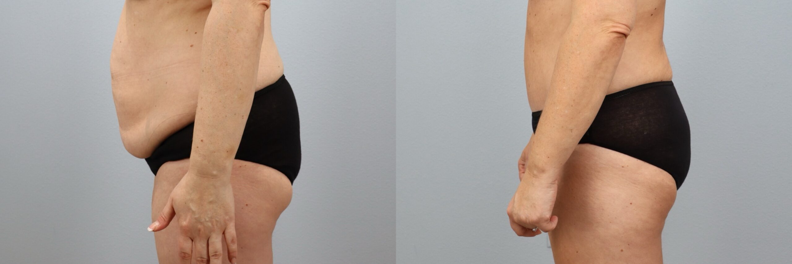 Before and after – Male Surgery – Female patient, age 40-49 – Image 47