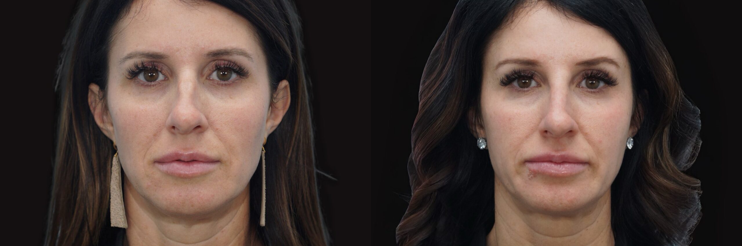 Before and after – Medi Spa – Female patient, age 40-49 – Image 1