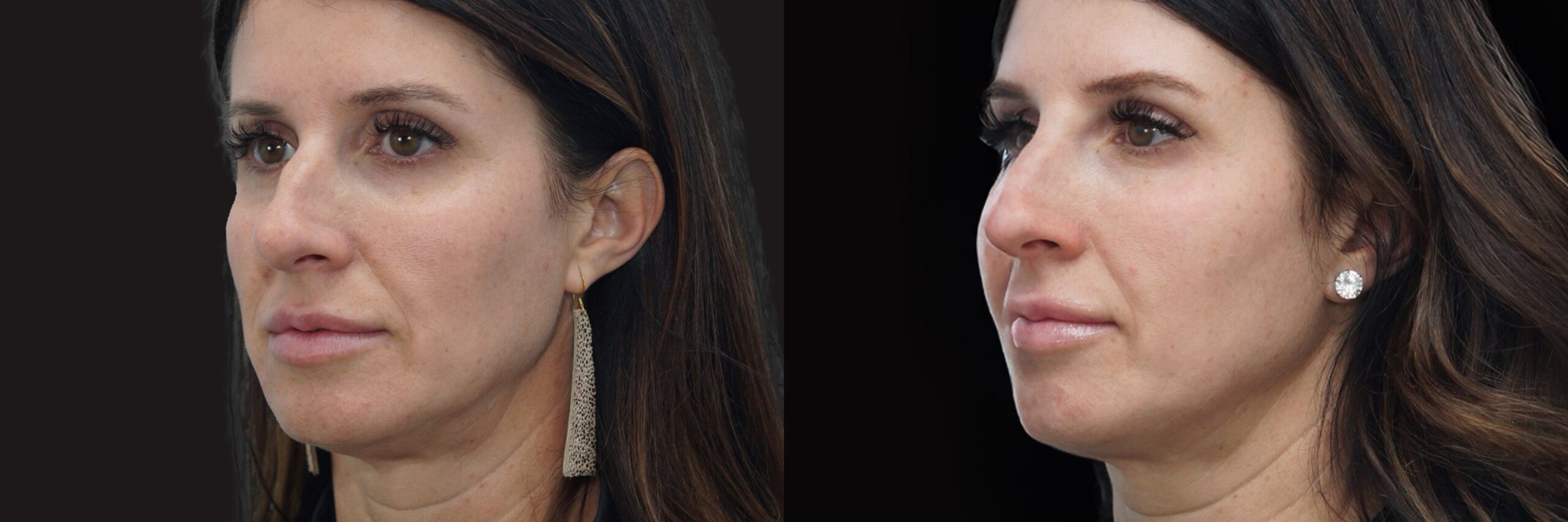 Before and after – Medi Spa – Female patient, age 40-49 – Image 2