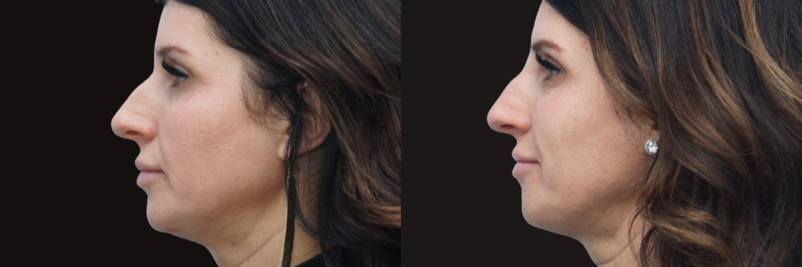 Before and after – Medi Spa – Female patient, age 40-49 – Image 3