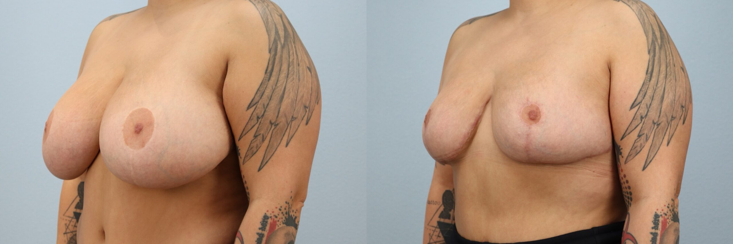 Before and after – Breast Reduction – Female patient, age 30-39 – Image 2