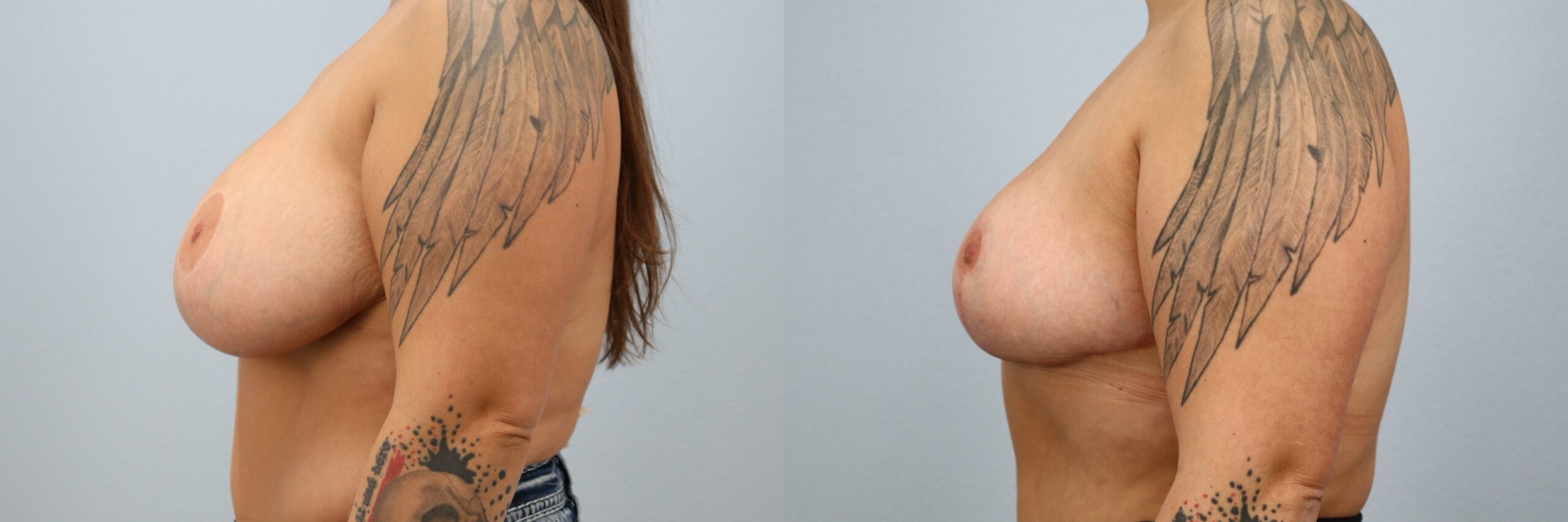 Before and after – Breast Reduction – Female patient, age 30-39 – Image 3