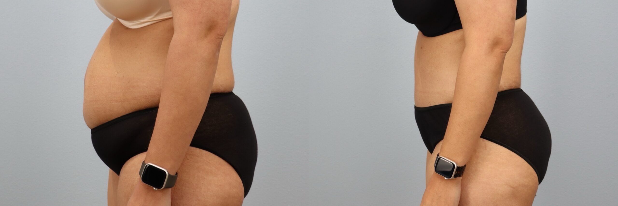 Before and after – Male Surgery – Female patient, age 30-39 – Image 24