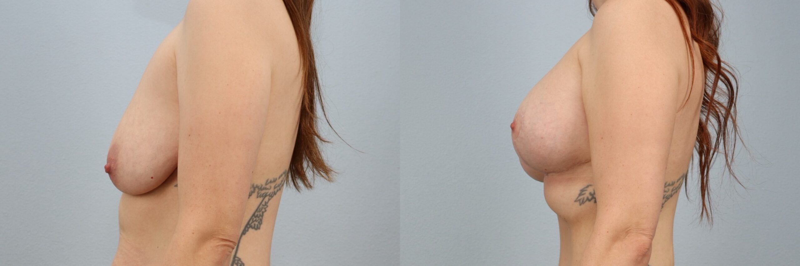 Before and after – Breast Lift With Implants – Female patient, age 30-39 – Image 39