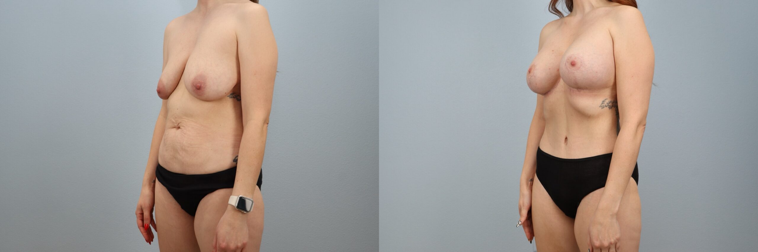 Before and after – Mommy Makeover – Female patient, age 30-39 – Image 29