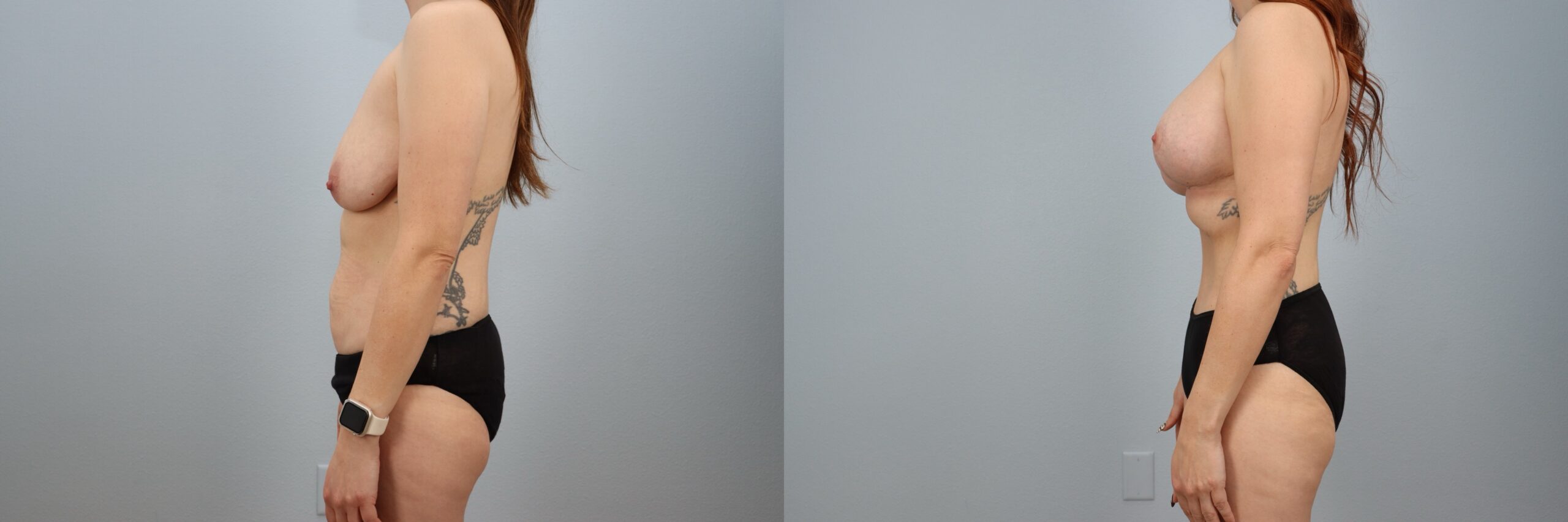 Before and after – Mommy Makeover – Female patient, age 30-39 – Image 30