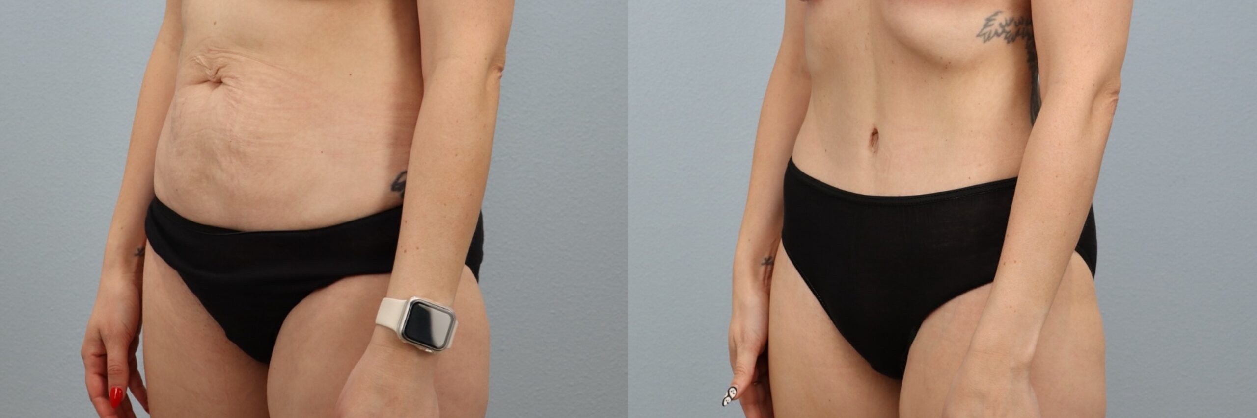 Before and after – Male Surgery – Female patient, age 30-39 – Image 20