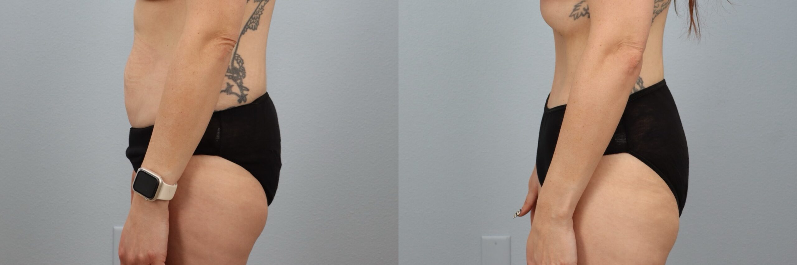 Before and after – Male Surgery – Female patient, age 30-39 – Image 21