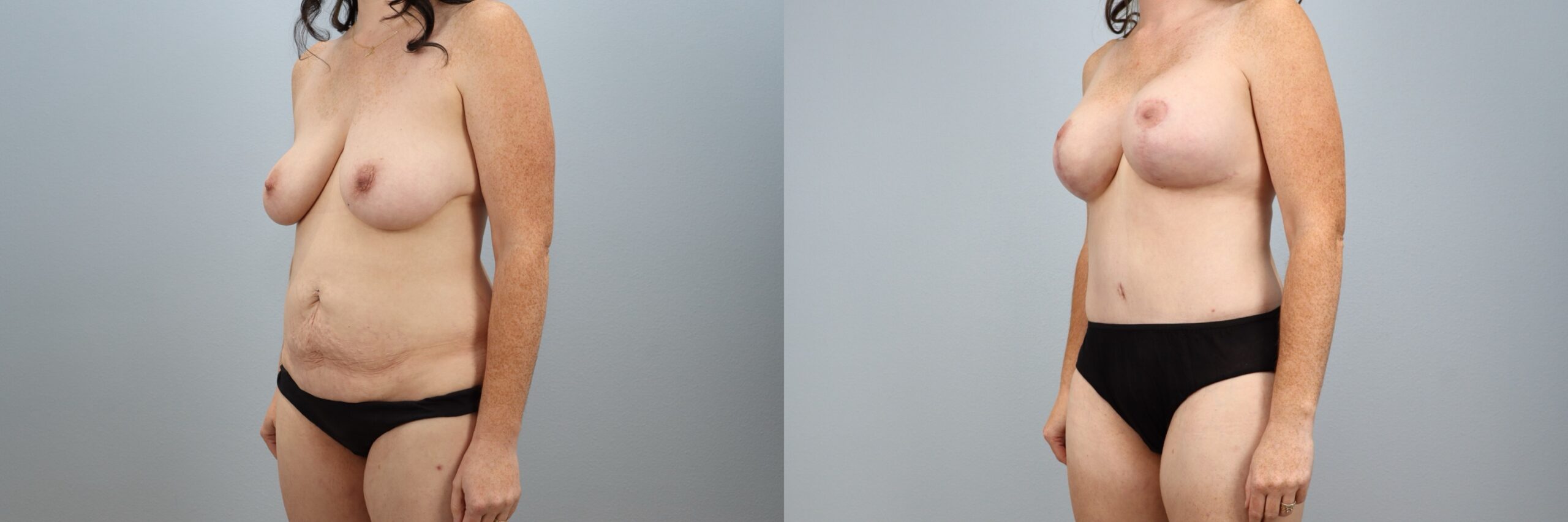 Before and after – Body Contouring – Female patient, age 30-39 – Image 30