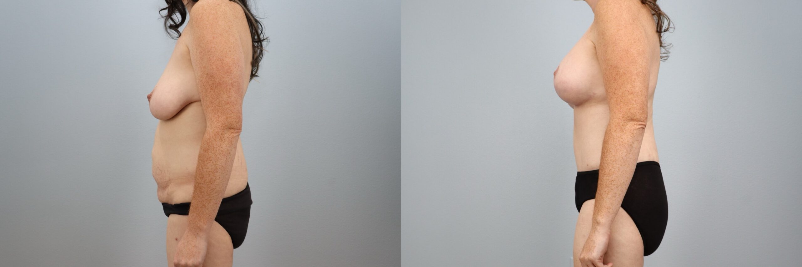 Before and after – Body Contouring – Female patient, age 30-39 – Image 31