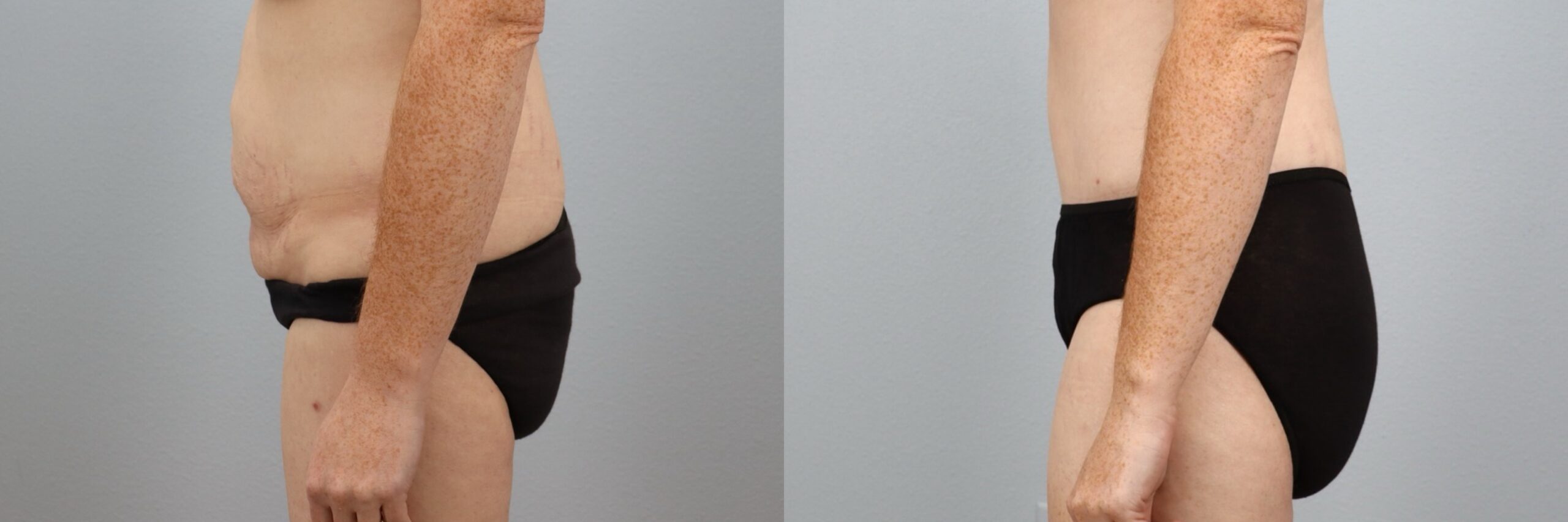 Before and after – Male Surgery – Female patient, age 30-39 – Image 37