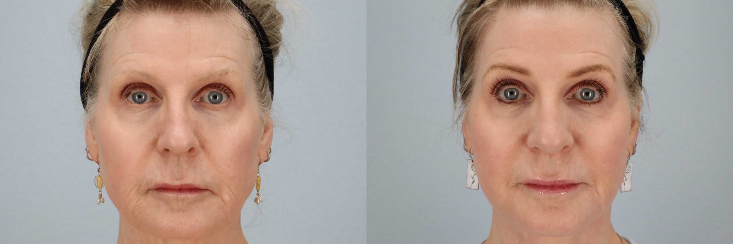 Before and after – Facial Surgery – Female patient, age 60+ – Image 28
