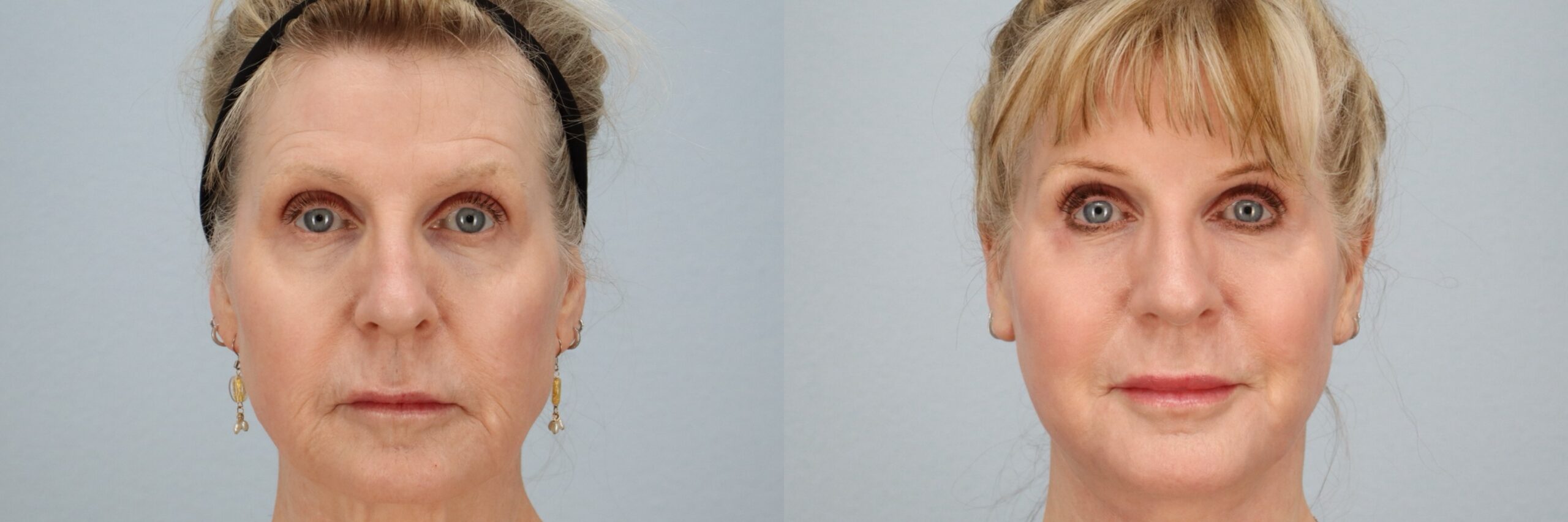 Before and after – Laser Resurfacing – Female patient, age 60+ – Image 1