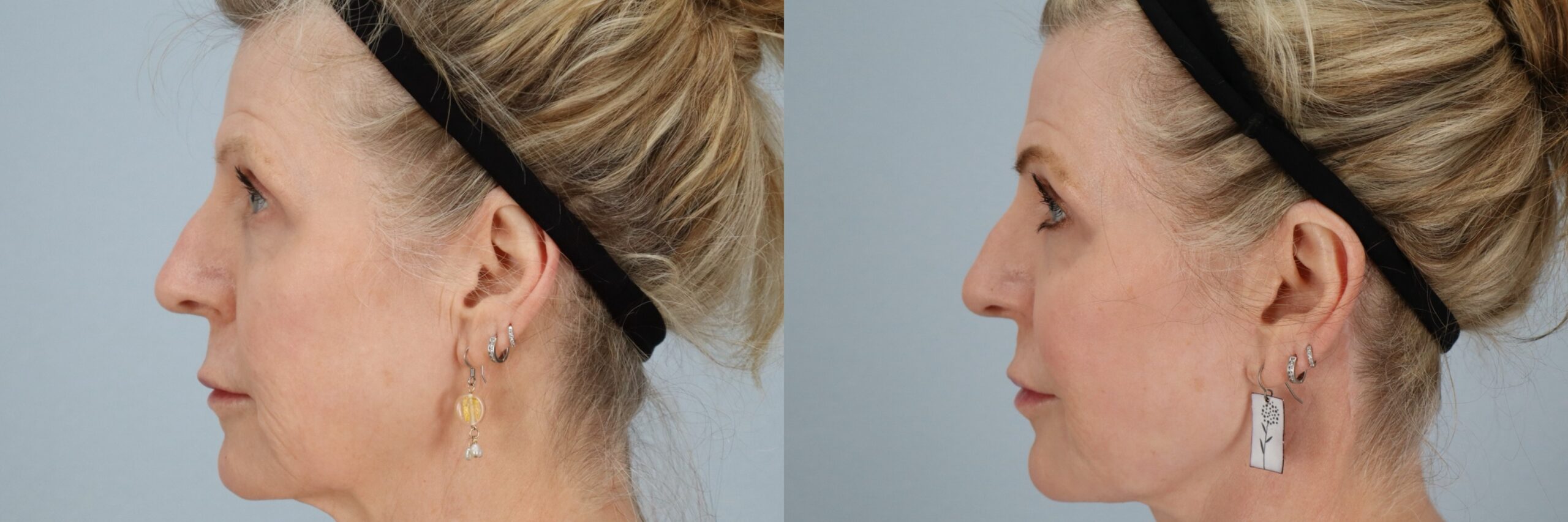 Before and after – Facial Surgery – Female patient, age 60+ – Image 30