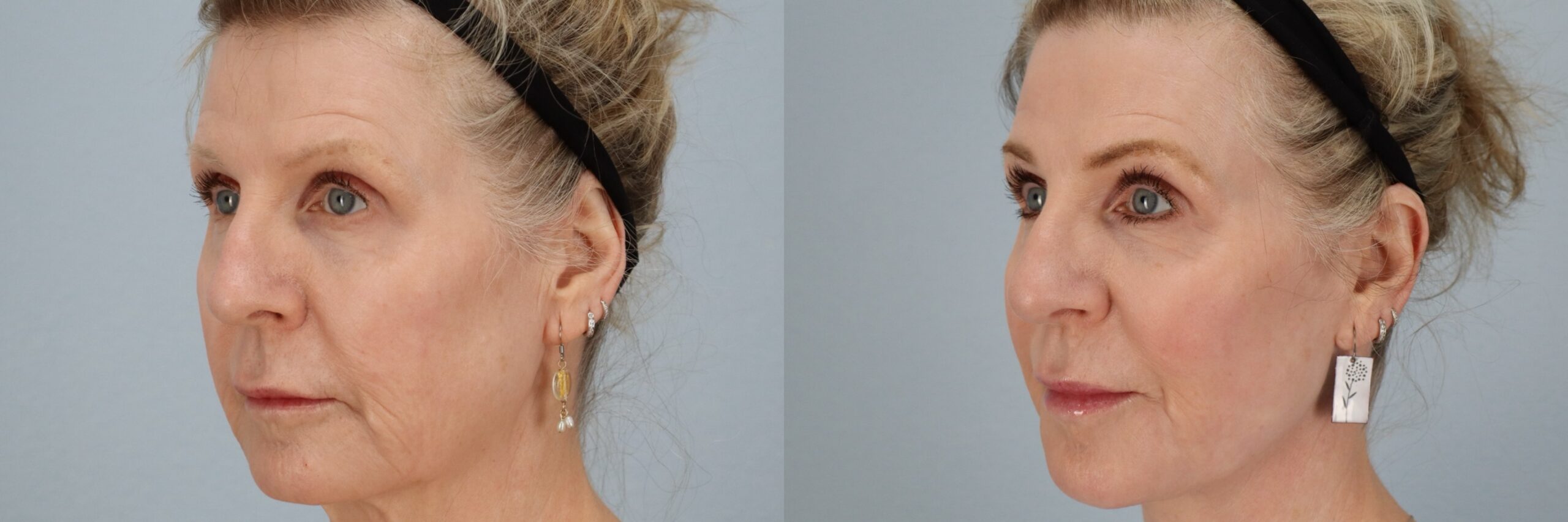 Before and after – Facial Surgery – Female patient, age 60+ – Image 29