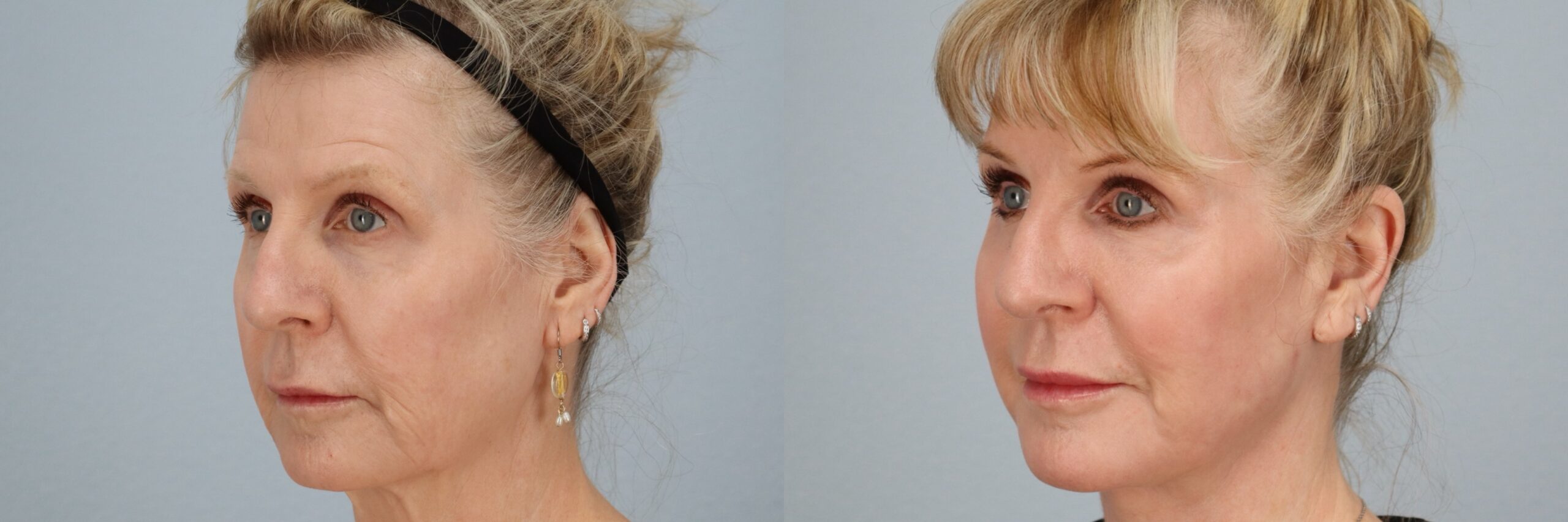 Before and after – Laser Resurfacing – Female patient, age 60+ – Image 2