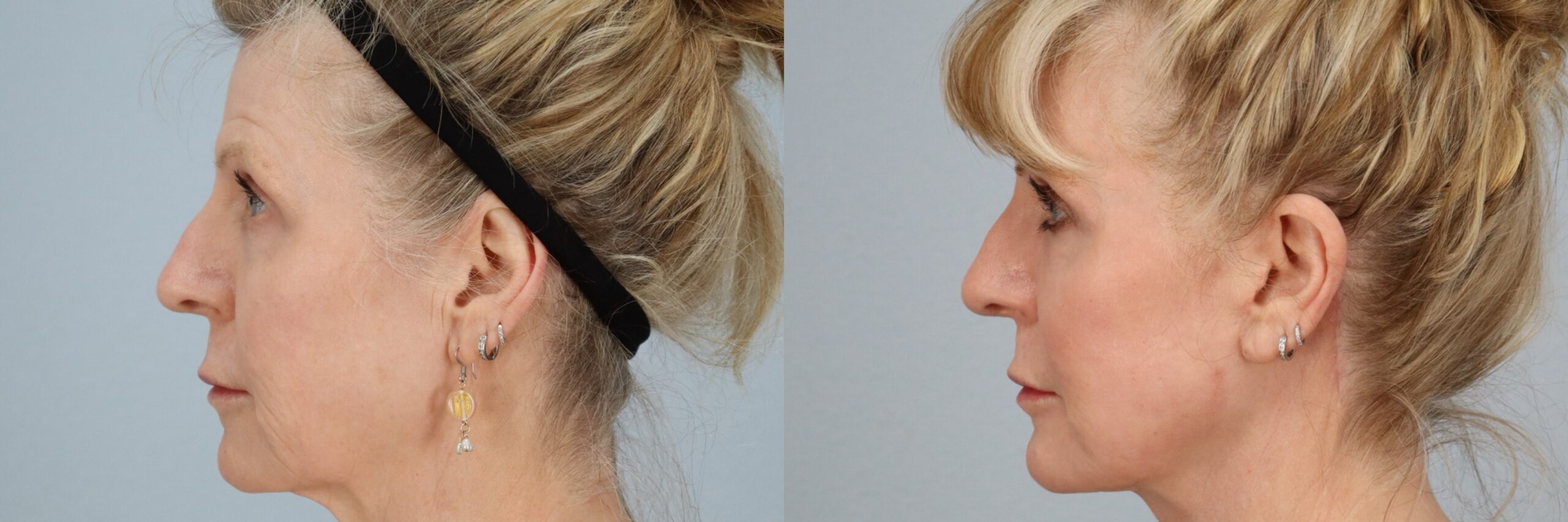 Before and after – Laser Resurfacing – Female patient, age 60+ – Image 3