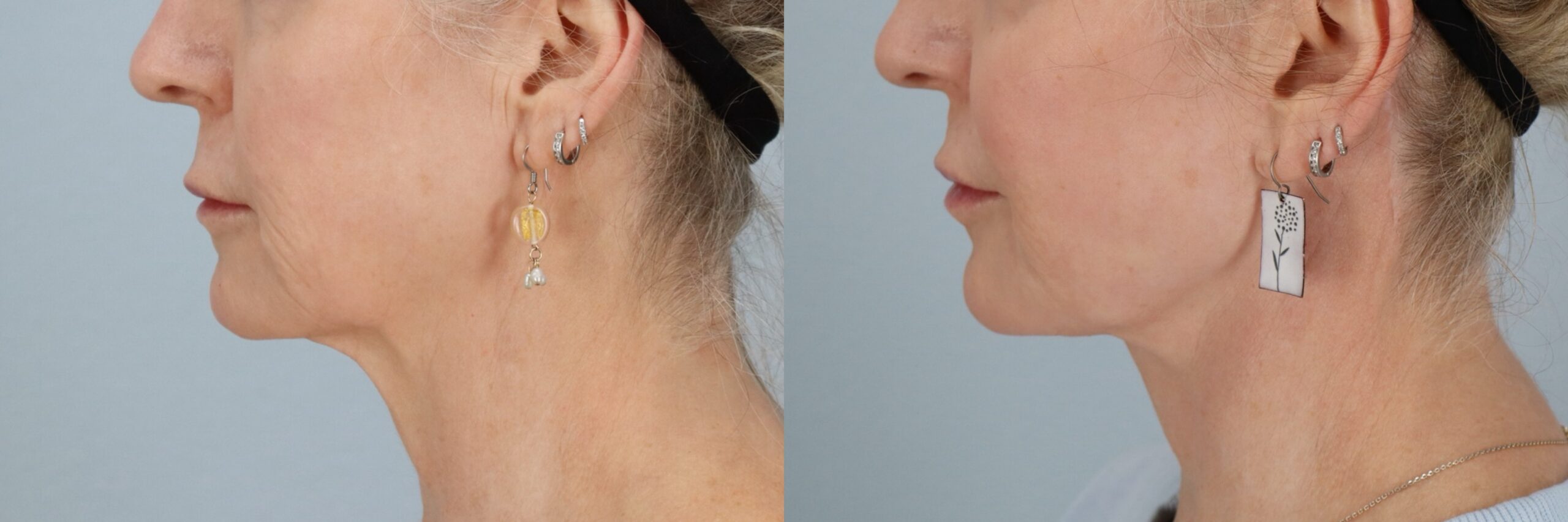 Before and after – Facial Surgery – Female patient, age 60+ – Image 11