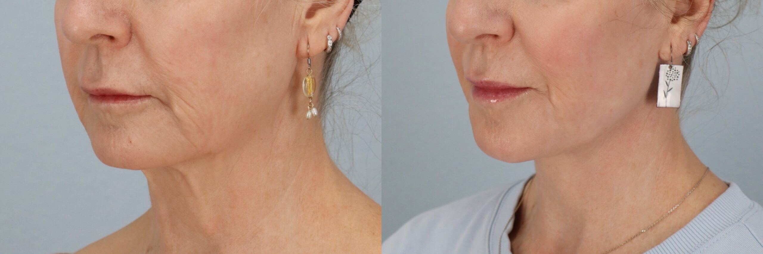 Before and after – Facial Surgery – Female patient, age 60+ – Image 10