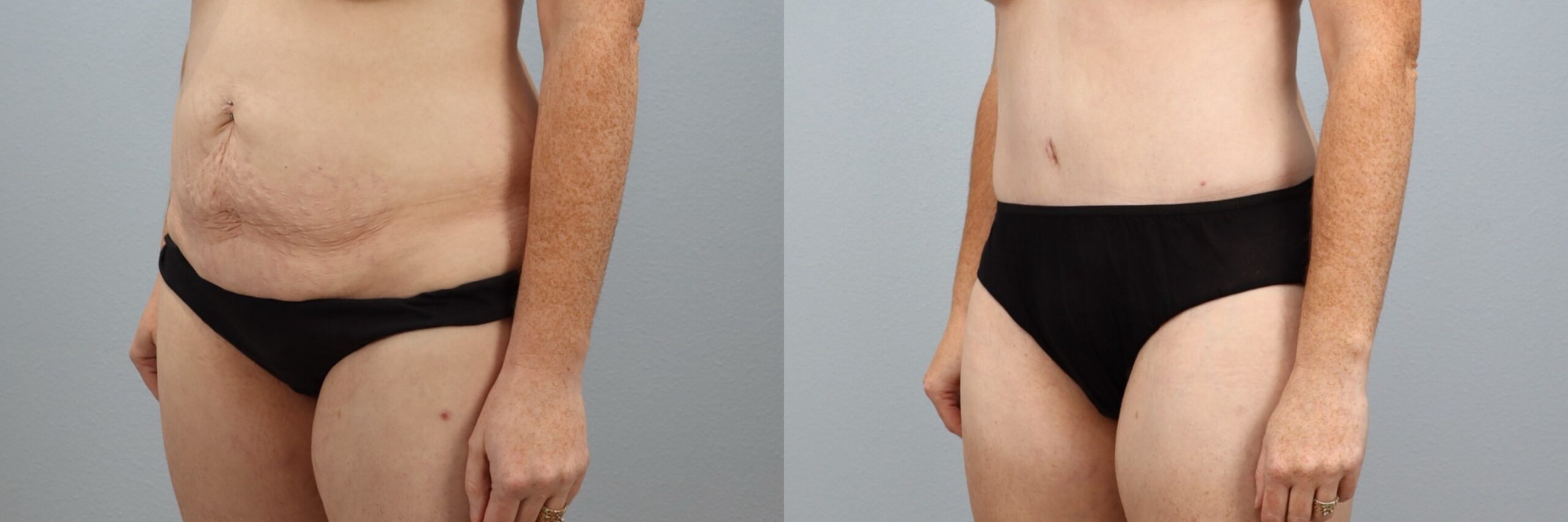 Before and after – Male Surgery – Female patient, age 30-39 – Image 36