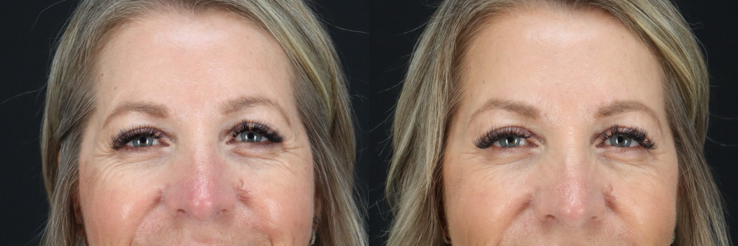 Before and after – Medi Spa – Female patient, age 50-59 – Image 44