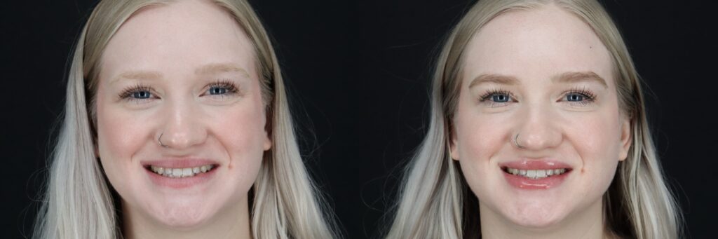 ER Botox Smiling