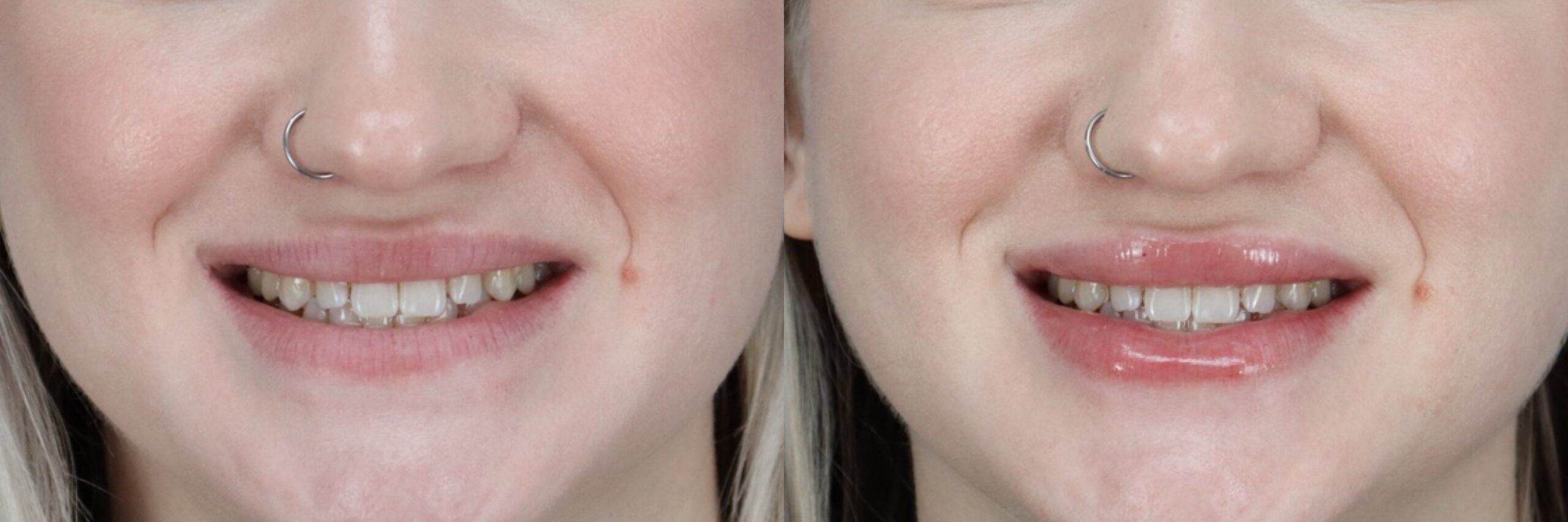 Before and after – Filler – Female patient, age 20-29 – Image 8