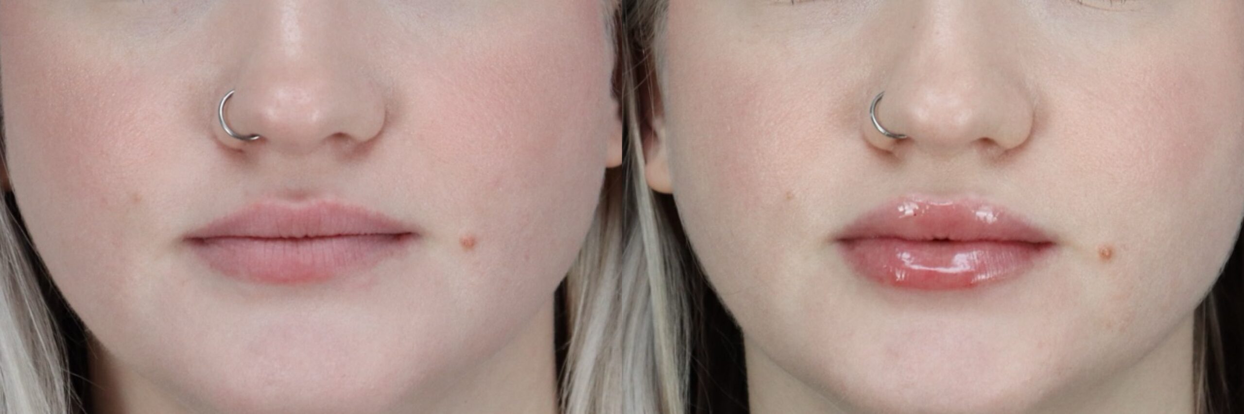 Before and after – Filler – Female patient, age 20-29 – Image 7