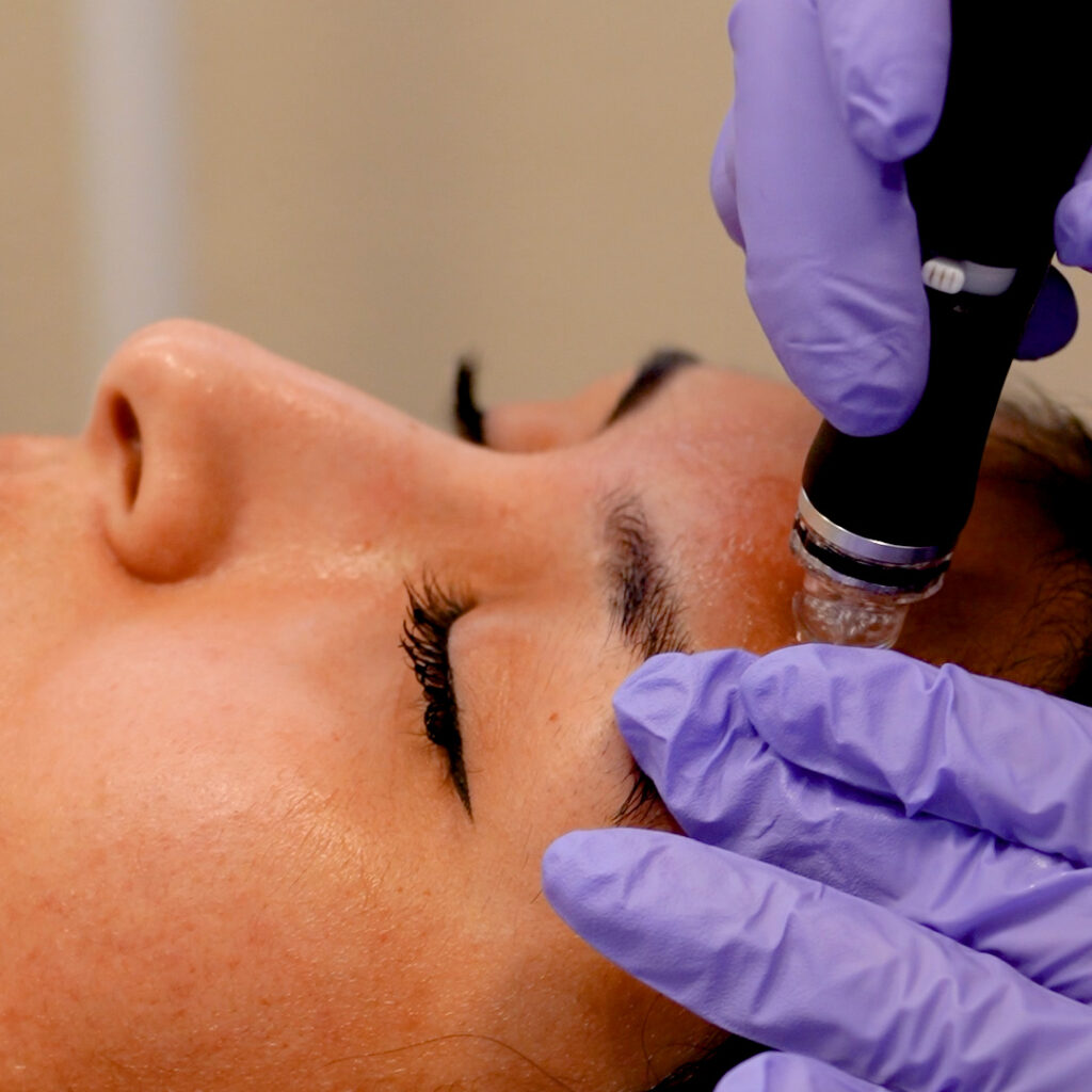 hydrafacial treatment forehead