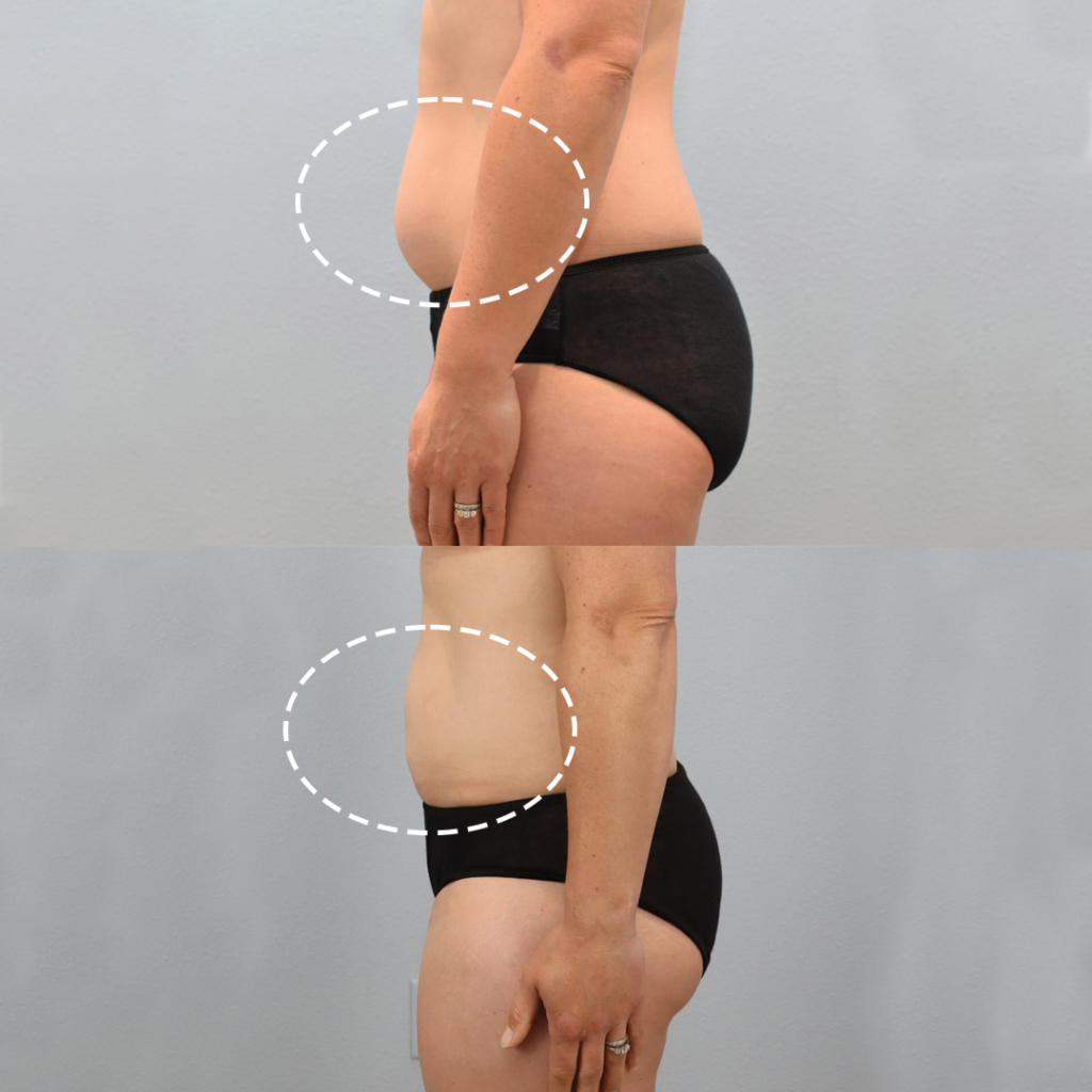 liposuction example 3