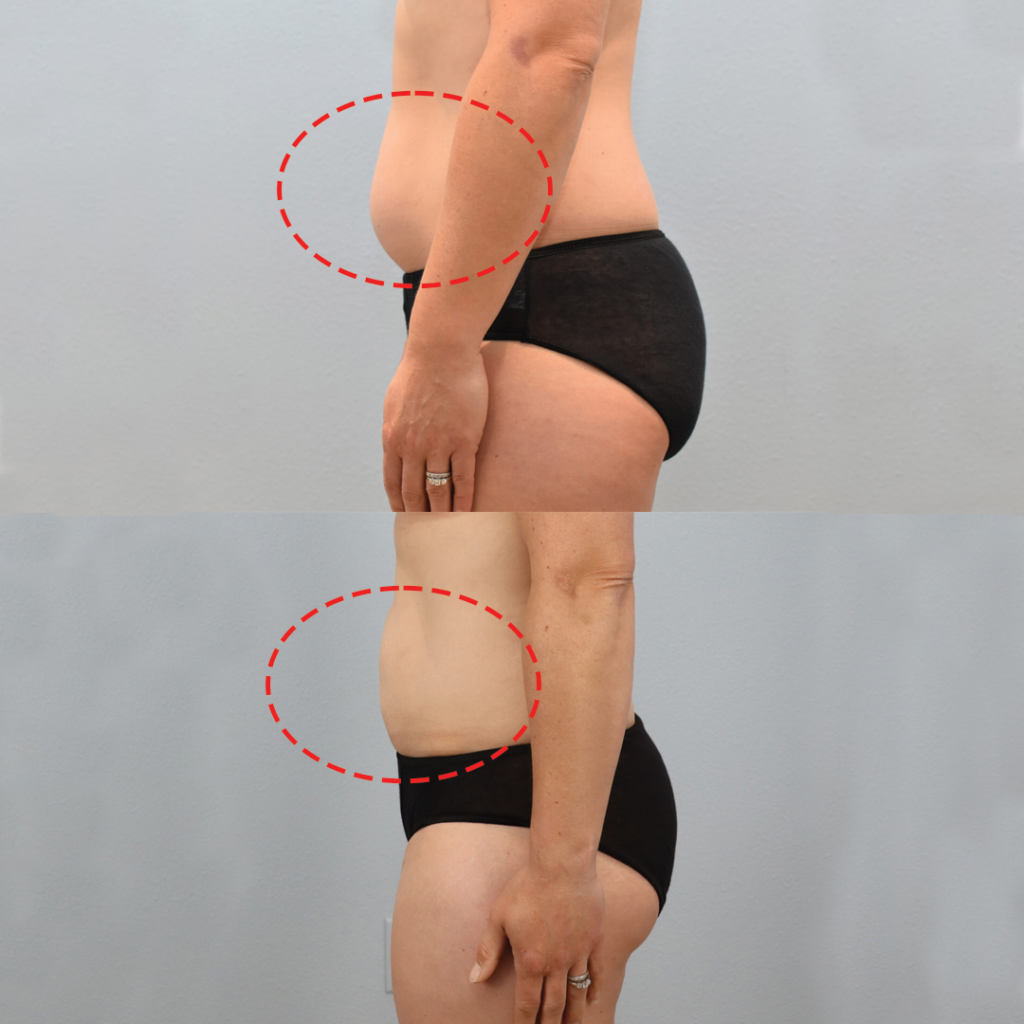 liposuction example 2