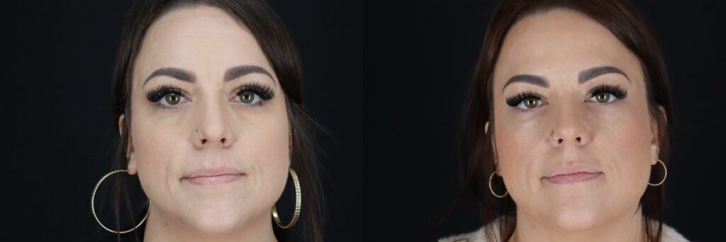MS Botox Full Face