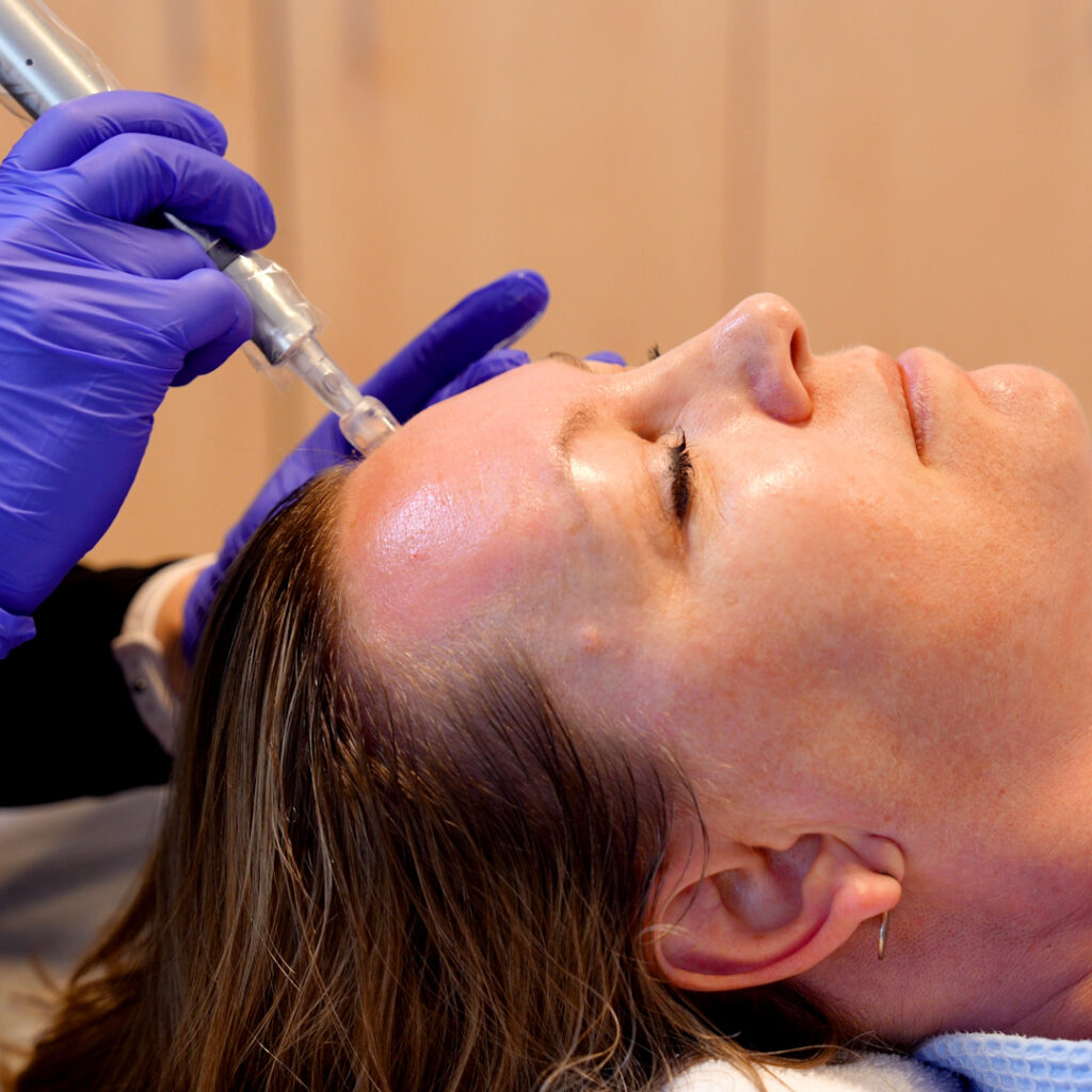 microneedling procedure