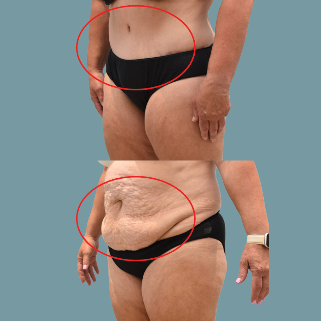 Tummy Tuck Example 1