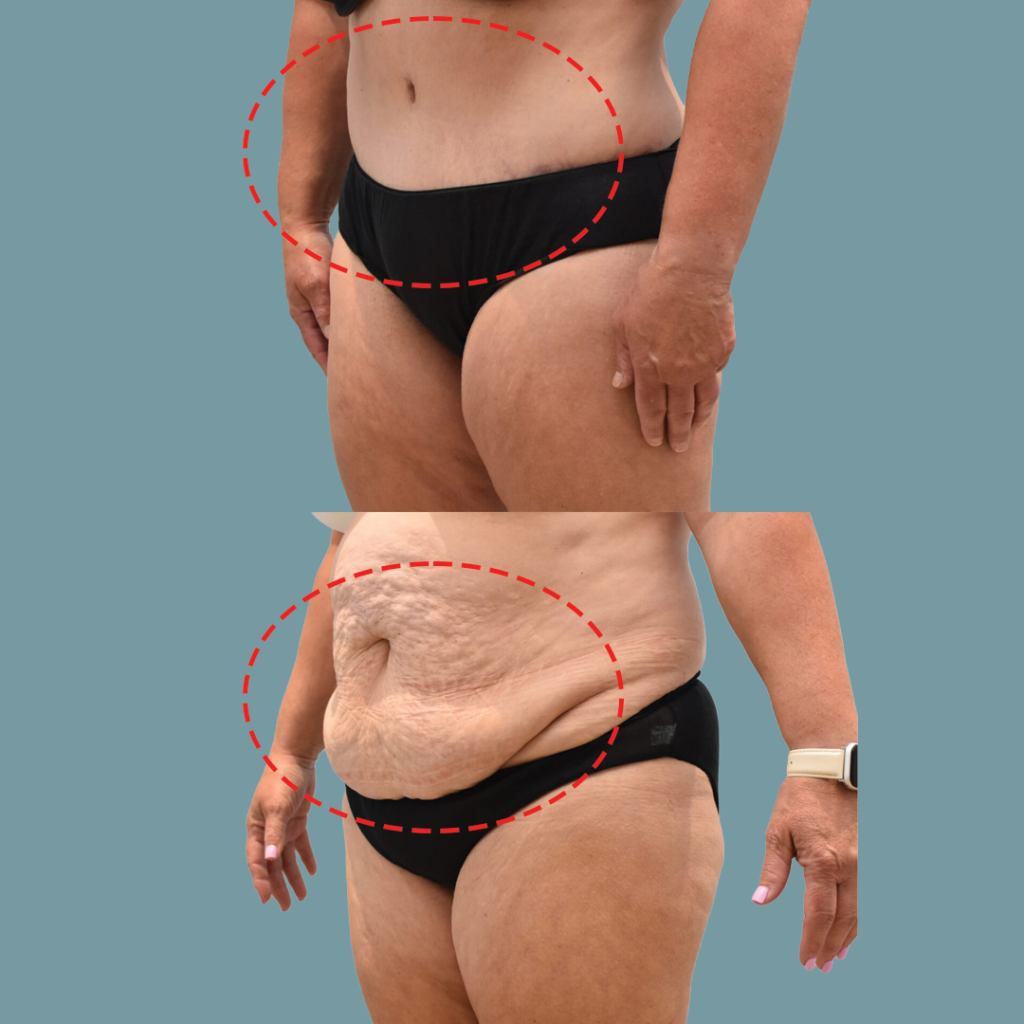 Tummy Tuck Example 2