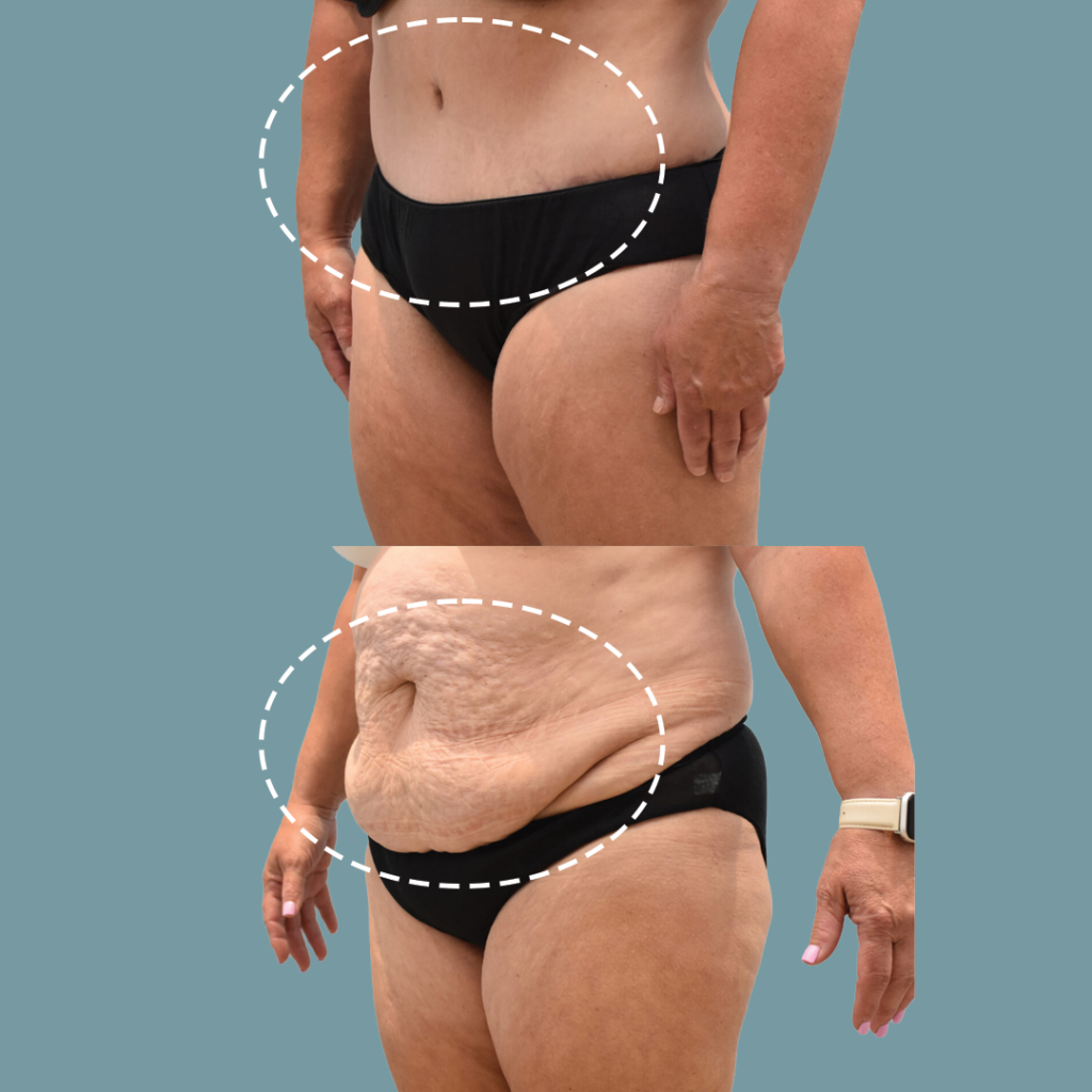 Tummy Tuck Example 3