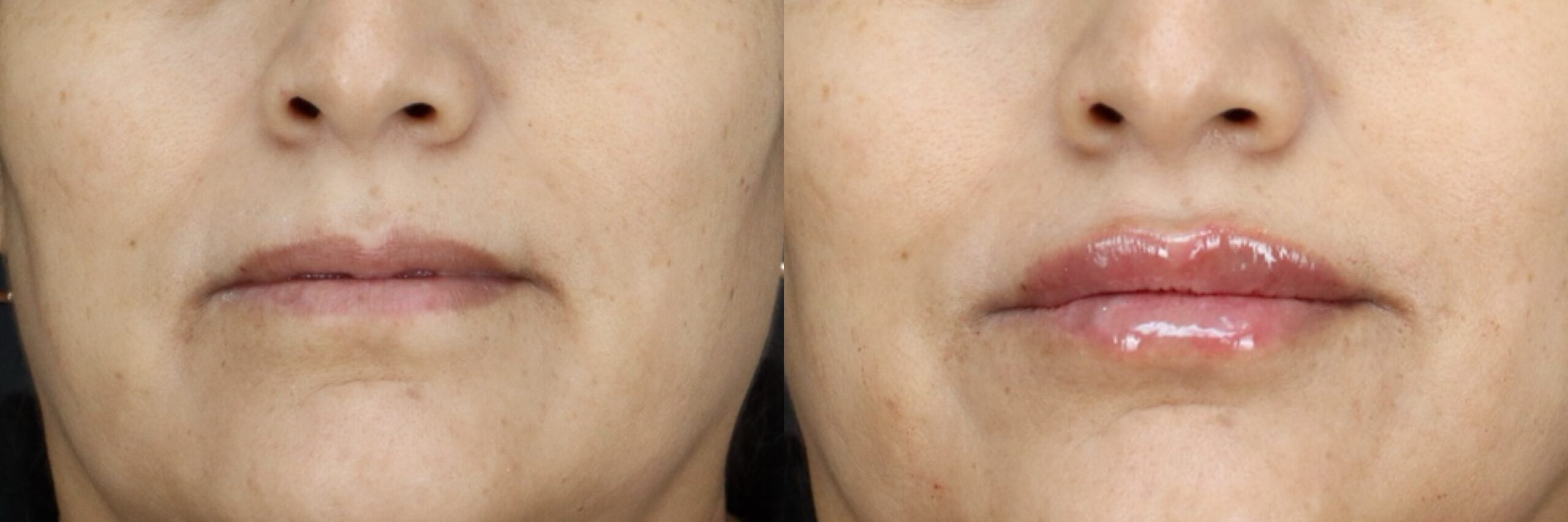 Before and after – Filler – Female patient, age 40-49 – Image 10
