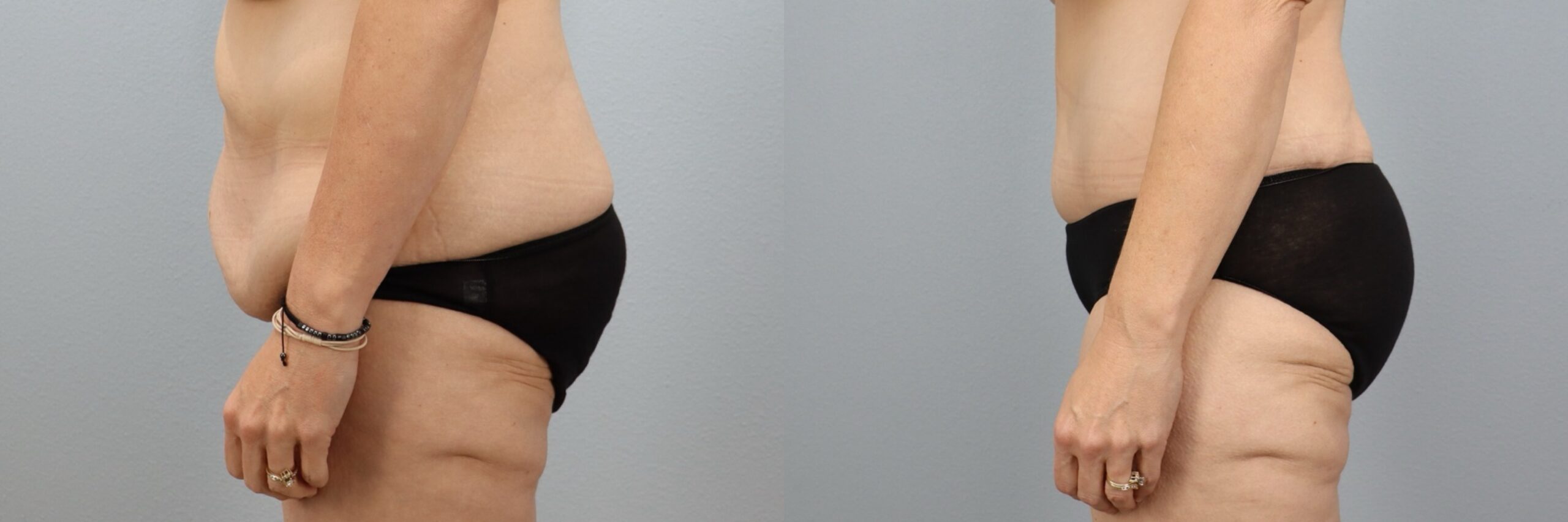 Before and after – Tummy Tuck – Female patient, age 50-59 – Image 27