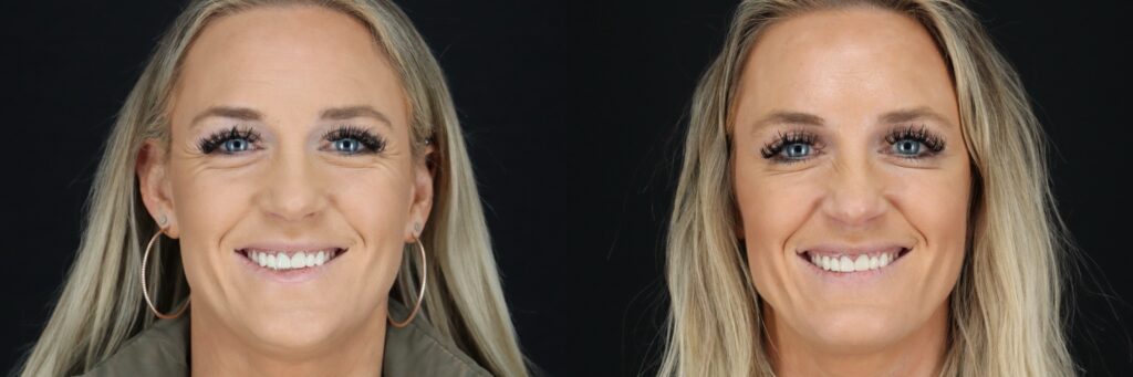 AG Botox Front Smile