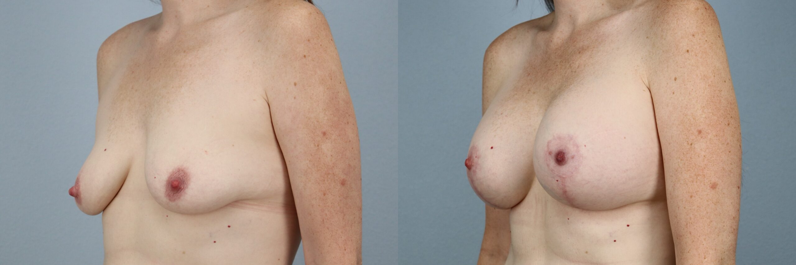 Before and after – Breast Lift With Implants – Female patient, age 40-49 – Image 50
