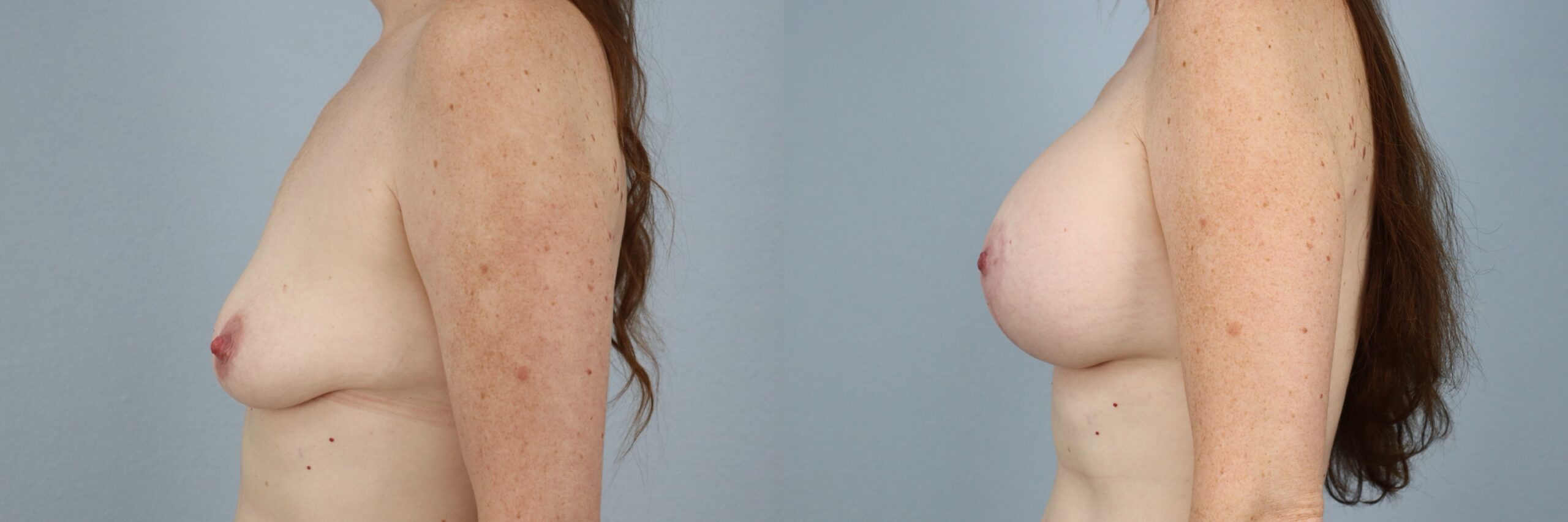 Before and after – Breast Lift With Implants – Female patient, age 40-49 – Image 51