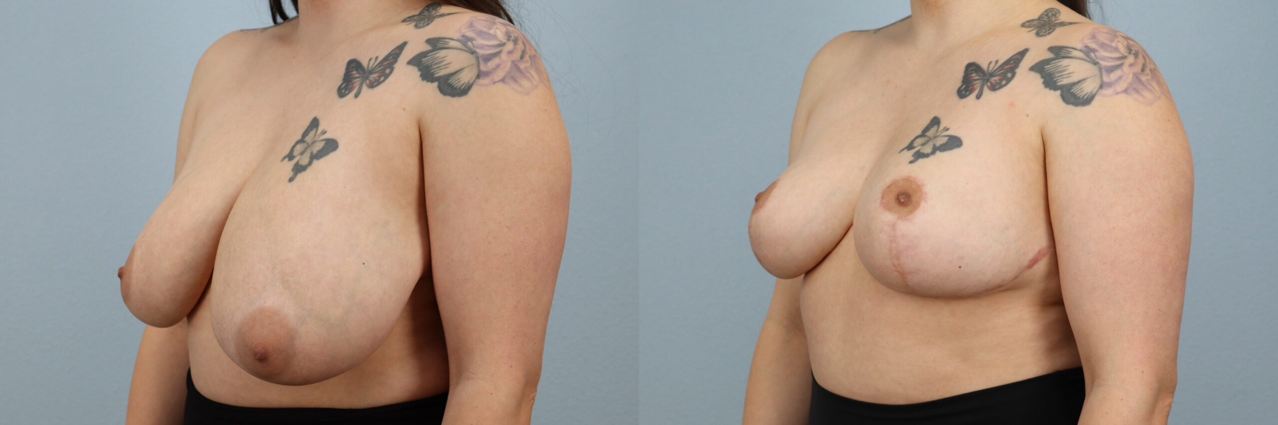 Before and after – Breast Reduction – Female patient, age 30-39 – Image 32