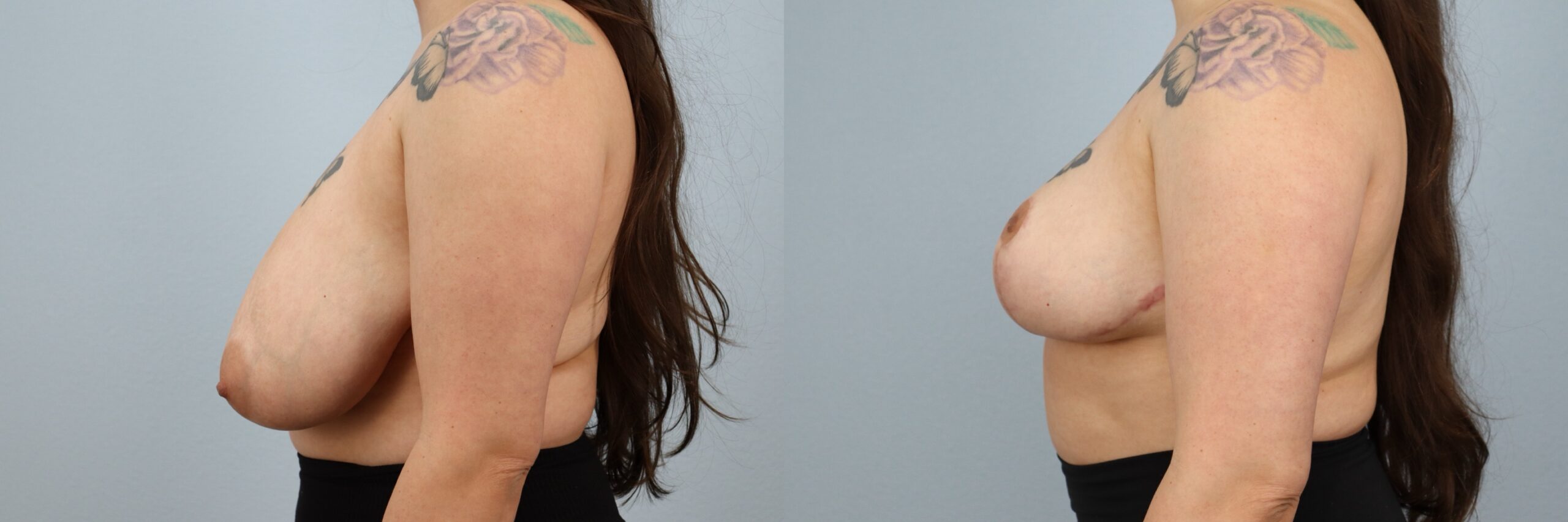 Before and after – Breast Reduction – Female patient, age 30-39 – Image 33