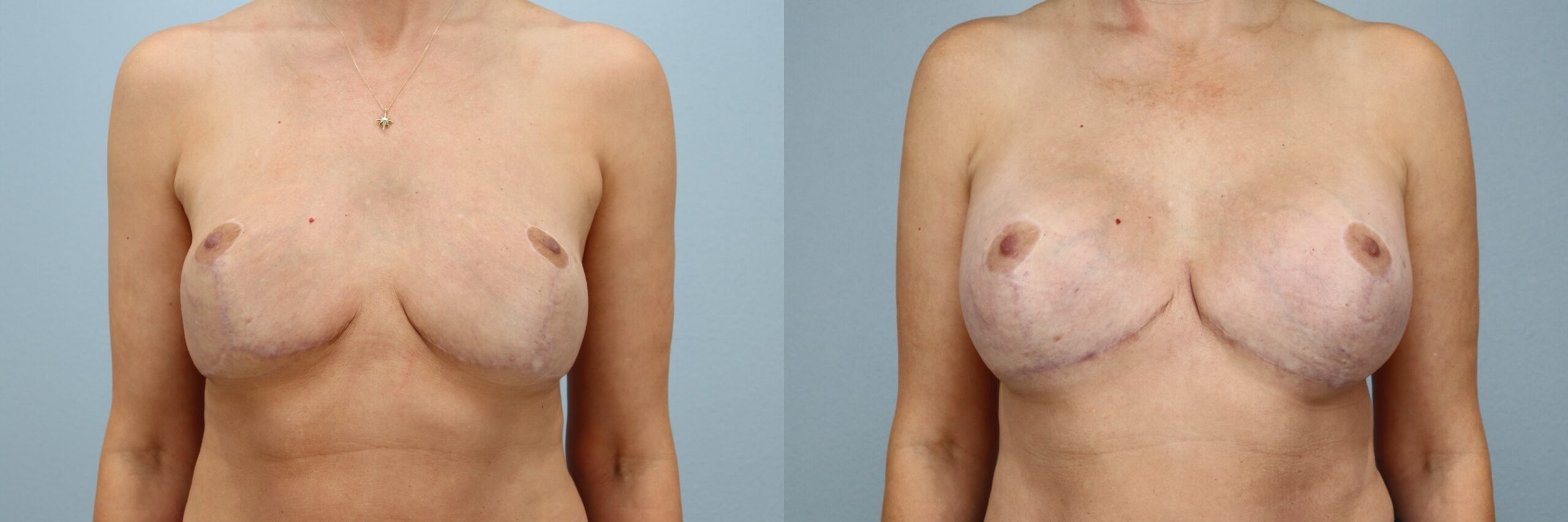 Before and after – Breast Revision – Female patient, age 40-49 – Image 40