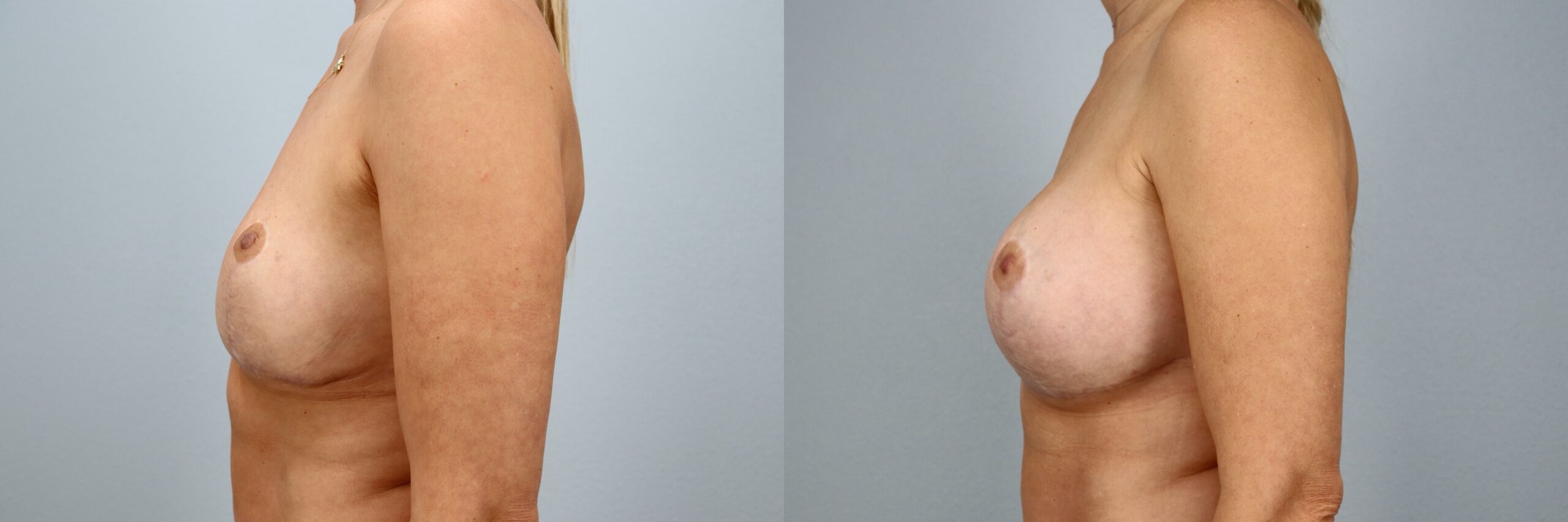 Before and after – Breast Revision – Female patient, age 40-49 – Image 42