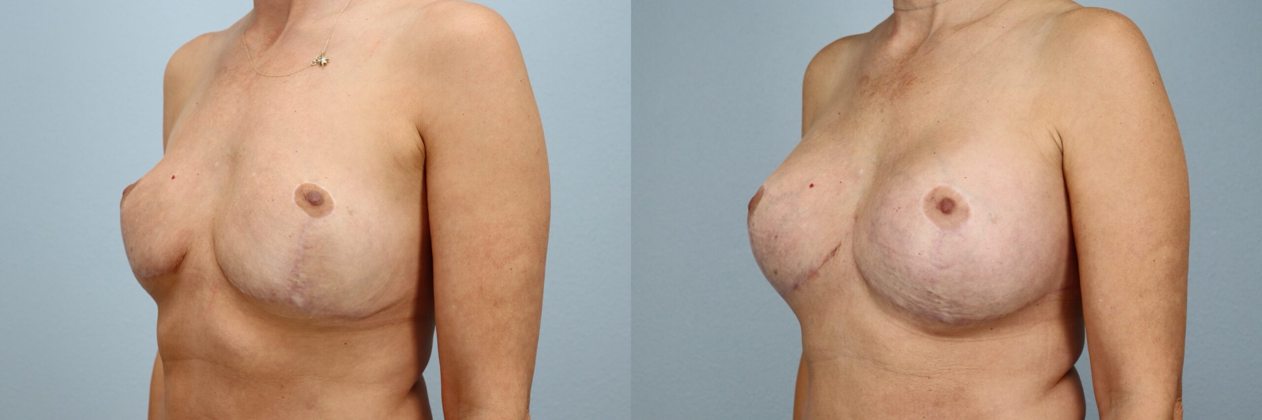 Before and after – Breast Revision – Female patient, age 40-49 – Image 41
