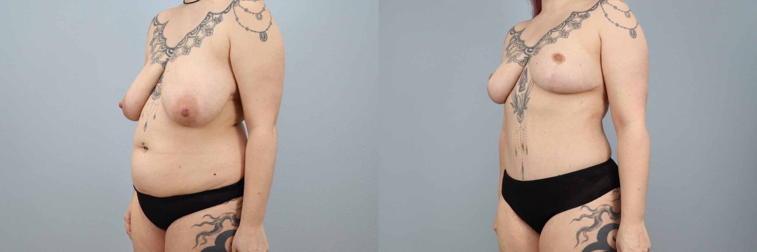 Before and after – Mommy Makeover – Female patient, age 30-39 – Image 35