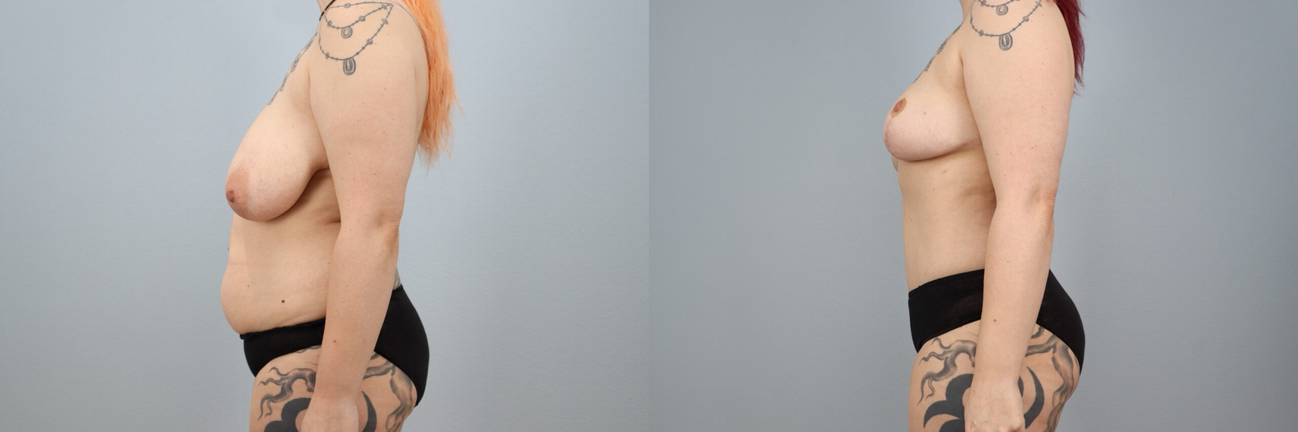 Before and after – Mommy Makeover – Female patient, age 30-39 – Image 36