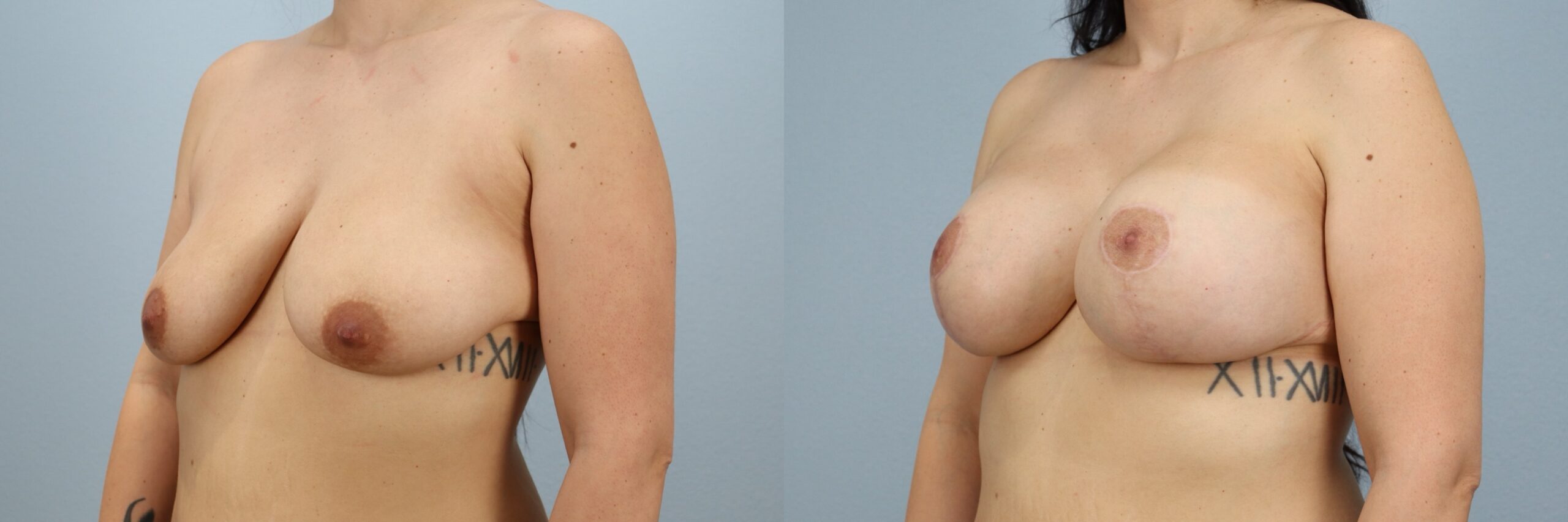 Before and after – Breast Lift With Implants – Female patient, age 20-29 – Image 53