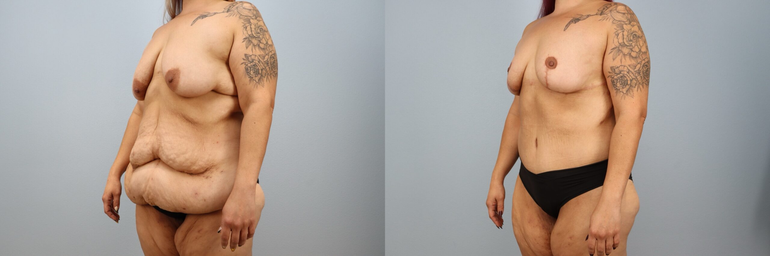 Before and after – Mommy Makeover – Female patient, age 40-49 – Image 41